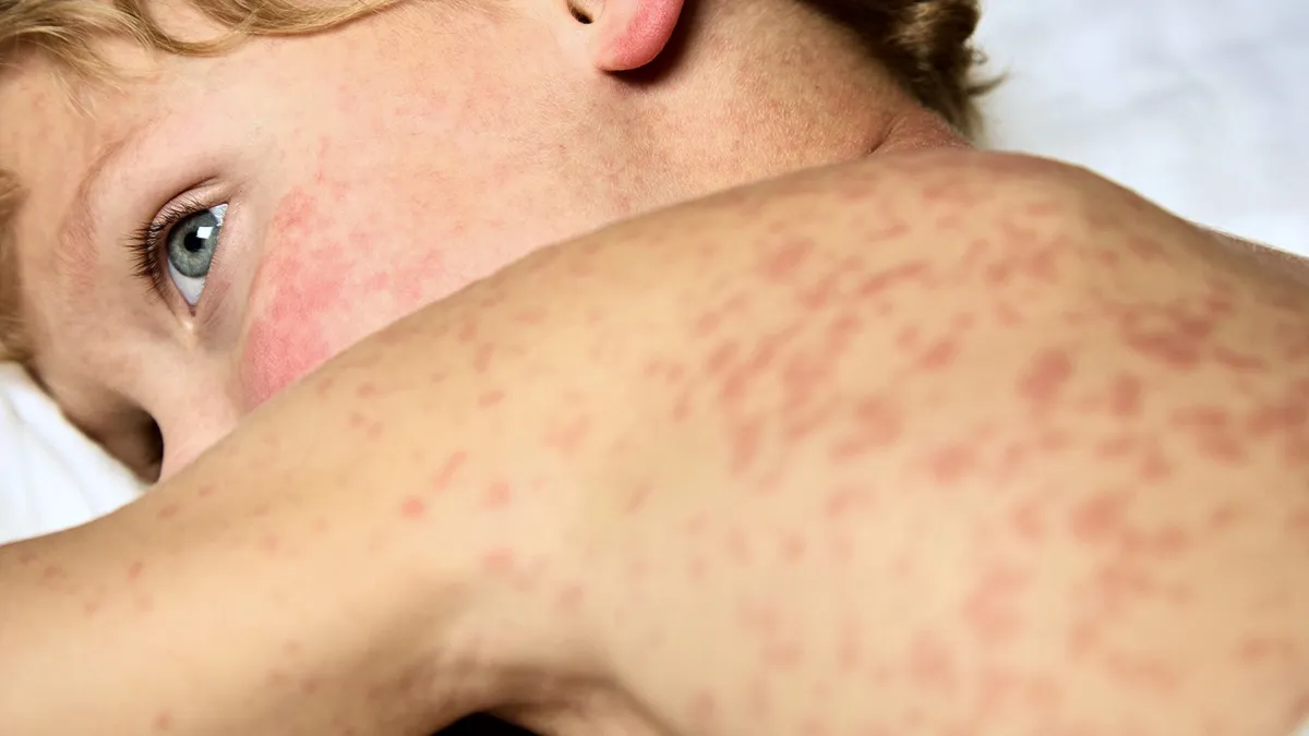 Vaccinazioni: solo 10 Regioni superano il 95% di copertura per la prima dose, nessuna per la seconda