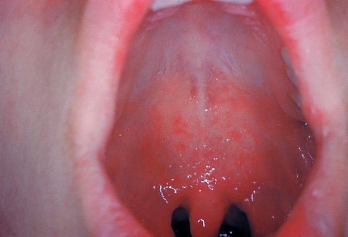 IL MORBILLO, COSA SAPERE