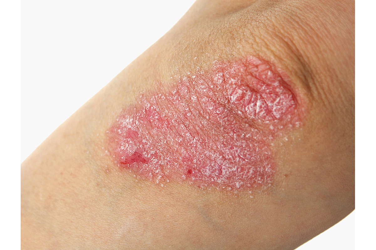 Psoriasi? Ecco come porvi rimedio in modo naturale